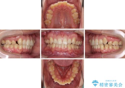 気になる八重歯を抜歯矯正で改善 補助装置を用いたインビザライン矯正の治療中