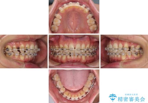 掃除しにくい前歯と閉じにくい口元 目立たないワイヤー装置での抜歯矯正の治療中