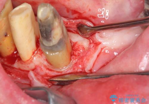 「 歯周病 再生治療 」再生治療で歯を残すの治療後