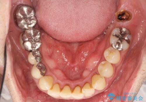 インプラント治療・セラミック治療を含む  全顎的虫歯治療の治療前