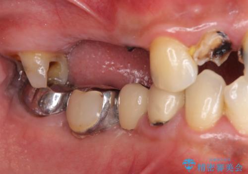 インプラント治療・セラミック治療を含む  全顎的虫歯治療の治療前