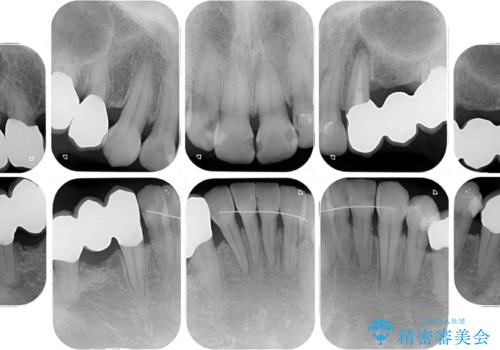 歯並びや奥歯の痛み 色々と治したい 総合歯科診療の治療後