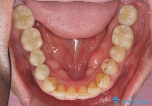 インプラント治療・セラミック治療を含む  全顎的虫歯治療の治療後