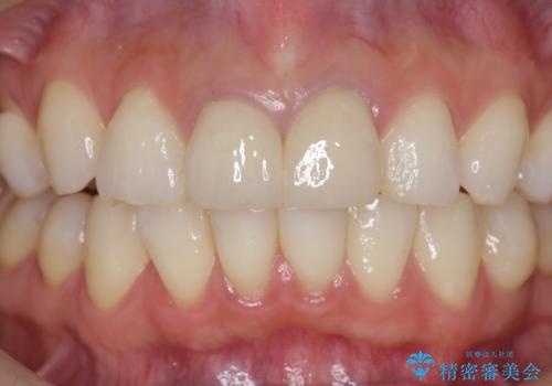 前歯が疼く セラミッククラウンのやり替えの治療後