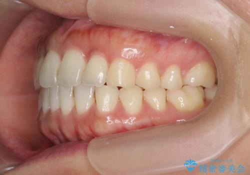 前歯のガタつきを治す　マウスピース矯正治療の治療後