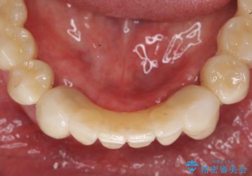 「 歯周病 再生治療 」再生治療で歯を残すの治療後