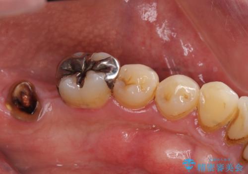 インプラント治療・セラミック治療を含む  全顎的虫歯治療の治療前