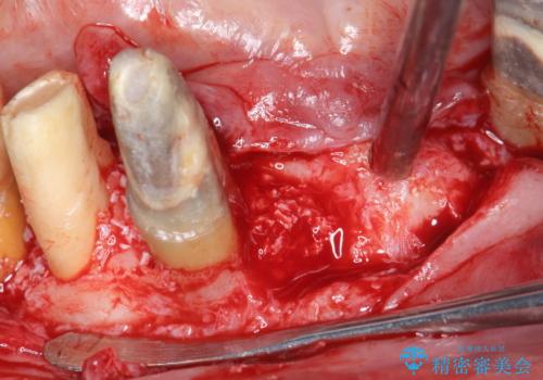 「 歯周病 再生治療 」再生治療で歯を残すの治療前