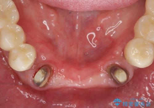 「 歯周病 再生治療 」再生治療で歯を残すの治療中