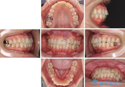 口元の突出感を治したい　治療中の歯も治したいの治療前