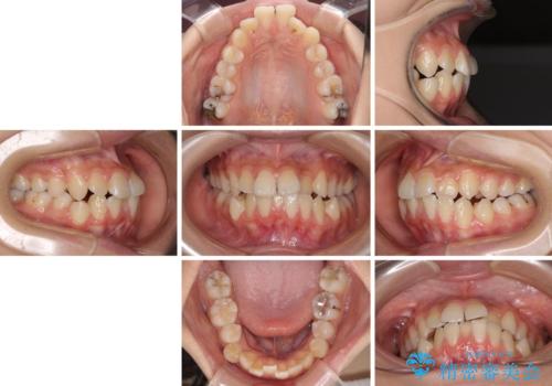 急速拡大装置で狭い歯列を骨格ごと改善 ワイヤー装置による矯正治療の治療前