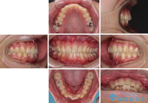 気になる前歯を治したい 短期間でのインビザライン矯正の治療前