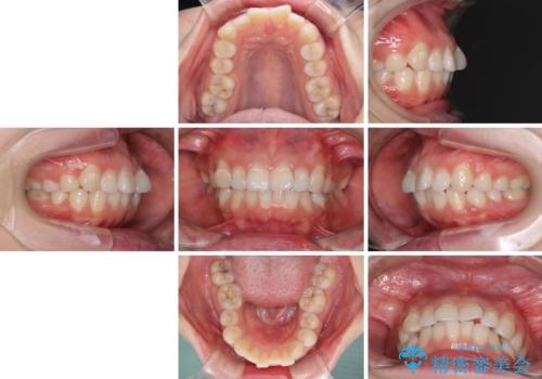 ふっくらとした口元を改善したい　目立たないワイヤー装置による抜歯矯正の治療前