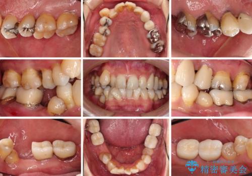 歯並びや奥歯の痛み 色々と治したい 総合歯科診療の治療前