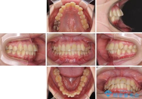 上下前歯のデコボコをきれいに インビザラインによる矯正治療の治療前