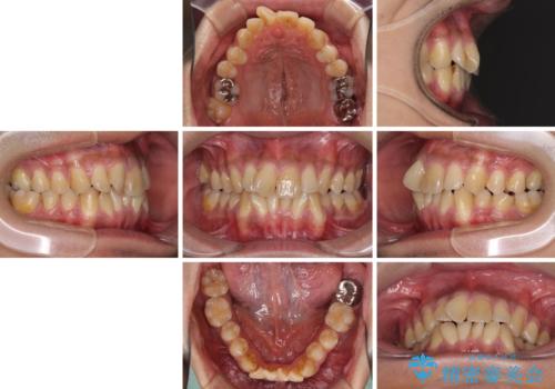 上顎の狭い歯列をインビザラインで拡大の治療前