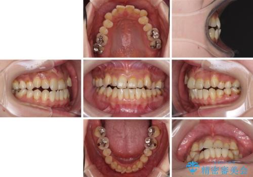 どこで咬んで良いのか分からない インビザラインでの咬み合わせの改善の治療前