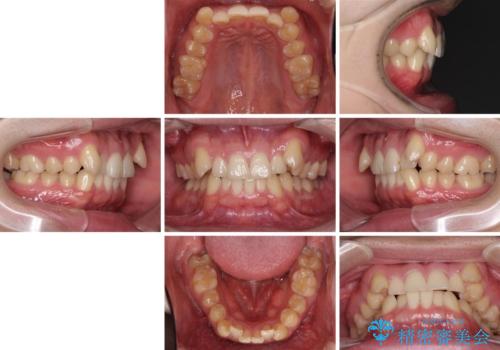 気になる八重歯を抜歯矯正で改善 補助装置を用いたインビザライン矯正の治療前