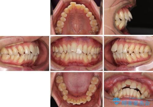 掃除しにくい前歯と閉じにくい口元 目立たないワイヤー装置での抜歯矯正の治療前