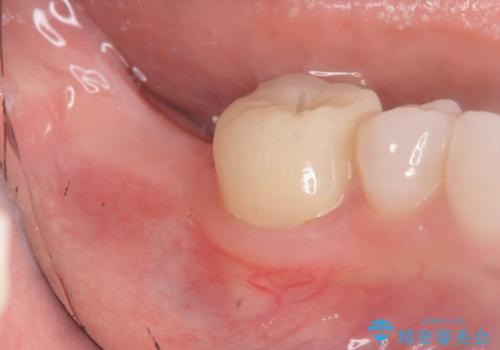 奥歯のインプラント治療の症例 治療前