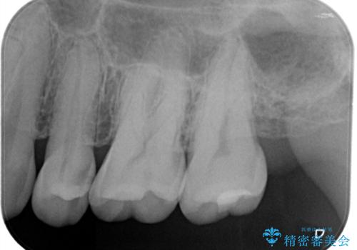 適合の良いセラミックインレー の治療前