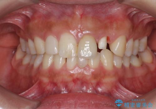 [ 歯が小さい ] 根管治療を伴う矮小歯治療の治療中