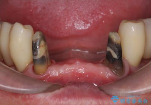 「 歯周病 再生治療 」再生治療で歯を残すの治療中