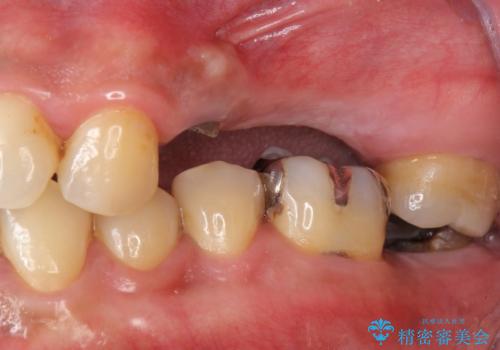インプラント治療・セラミック治療を含む  全顎的虫歯治療の治療前