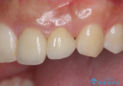 [ 歯が小さい ] 根管治療を伴う矮小歯治療の症例 治療後