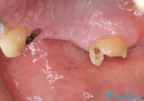 インプラント治療・セラミック治療を含む  全顎的虫歯治療の治療前