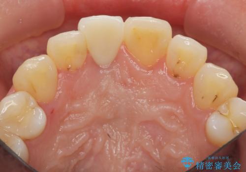 オーダーメイドで造る、自然な前歯セラミッククラウンの治療後