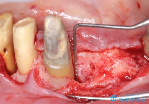「 歯周病 再生治療 」再生治療で歯を残すの治療前