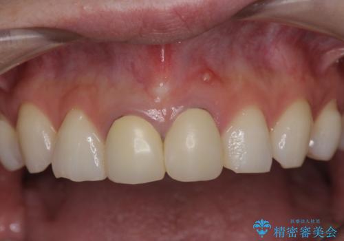 前歯が疼く セラミッククラウンのやり替えの治療前