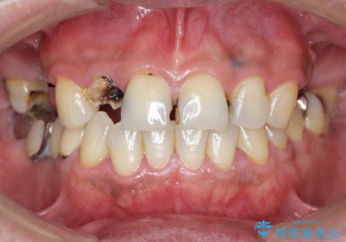 インプラント治療・セラミック治療を含む  全顎的虫歯治療の症例 治療前