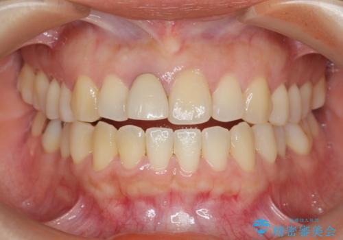 オーダーメイドで造る、自然な前歯セラミッククラウンの治療前