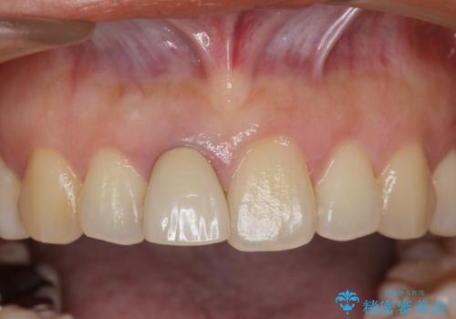 オーダーメイドで造る、自然な前歯セラミッククラウンの治療前