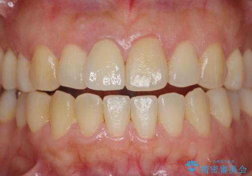 オーダーメイドで造る、自然な前歯セラミッククラウンの治療後