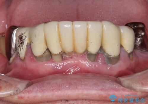 「 歯周病 再生治療 」再生治療で歯を残すの症例 治療前
