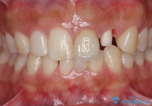 [ 歯が小さい ] 根管治療を伴う矮小歯治療の治療中