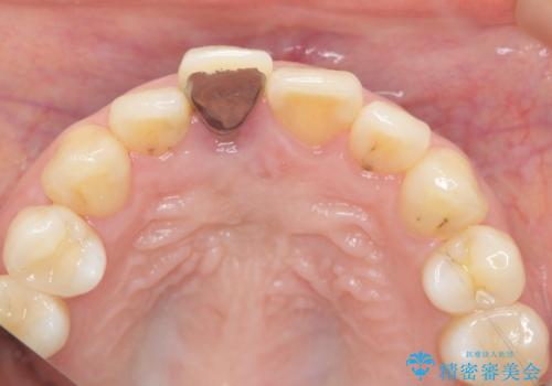 オーダーメイドで造る、自然な前歯セラミッククラウンの治療前