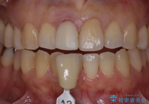 オーダーメイドで造る、自然な前歯セラミッククラウンの治療中