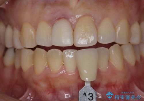 オーダーメイドで造る、自然な前歯セラミッククラウンの治療中