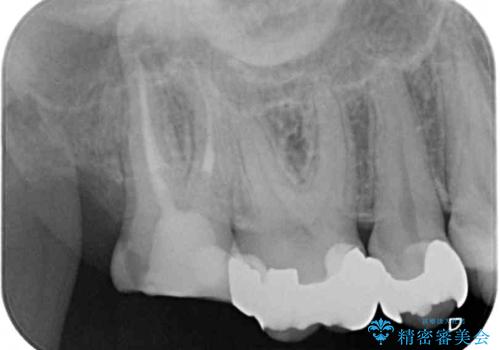 奥歯のむし歯が痛む セラミッククラウンとゴールドインレーによるむし歯治療の治療前
