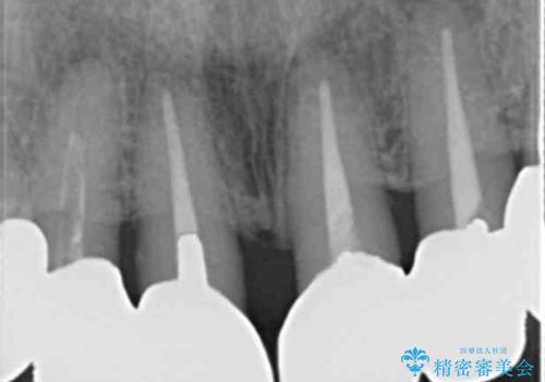 長持ちするセラミック 4年半経過症例 50代女性の治療前