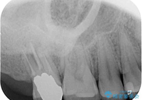 歯に穴を開けられてしまった　インプラントによる奥歯の補綴治療の治療前