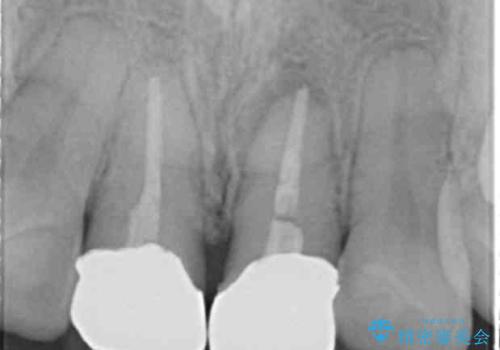 前歯が疼く セラミッククラウンのやり替えの治療前