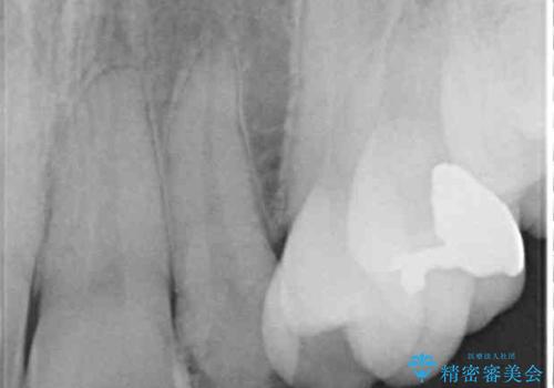 結婚式までに前歯をきれいにしたい 抜歯矯正とオールセラミッククラウンの治療前