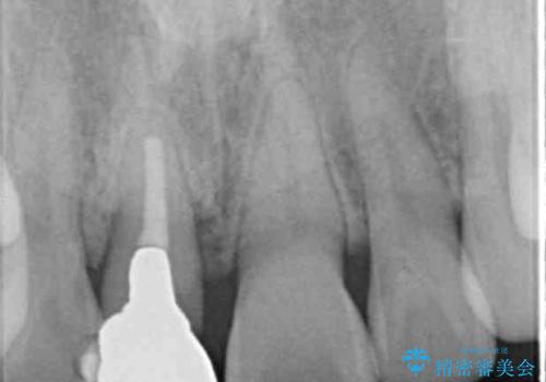 オーダーメイドで造る、自然な前歯セラミッククラウンの治療前