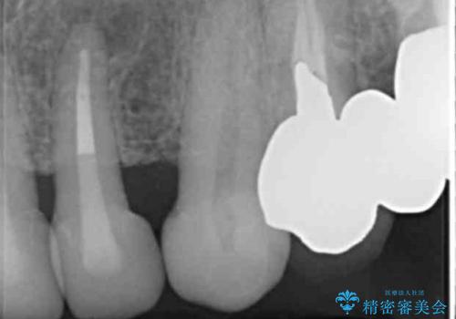 長持ちするセラミック 4年半経過症例 50代女性の治療中