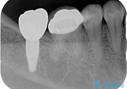 奥歯のインプラント治療の治療後